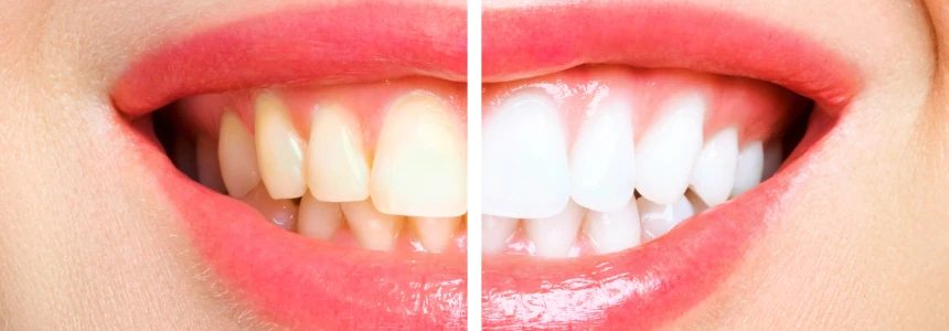 Teeth Whitening